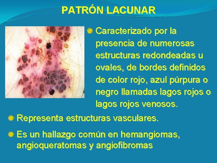 PATRÓN LACUNAR Caracterizado por la presencia de numerosas estructuras redondeadas u ovales, de bordes