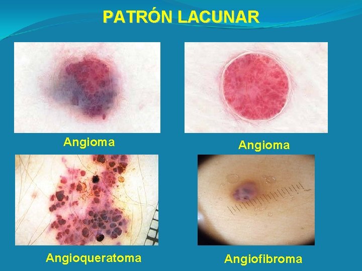 PATRÓN LACUNAR Angioma Angioqueratoma Angiofibroma 