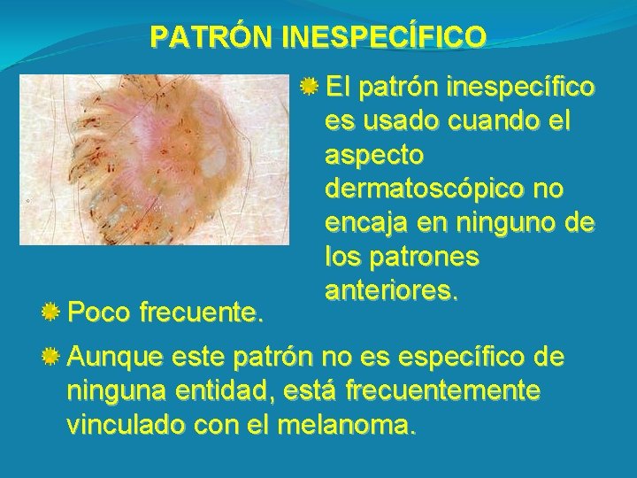 PATRÓN INESPECÍFICO Poco frecuente. El patrón inespecífico es usado cuando el aspecto dermatoscópico no