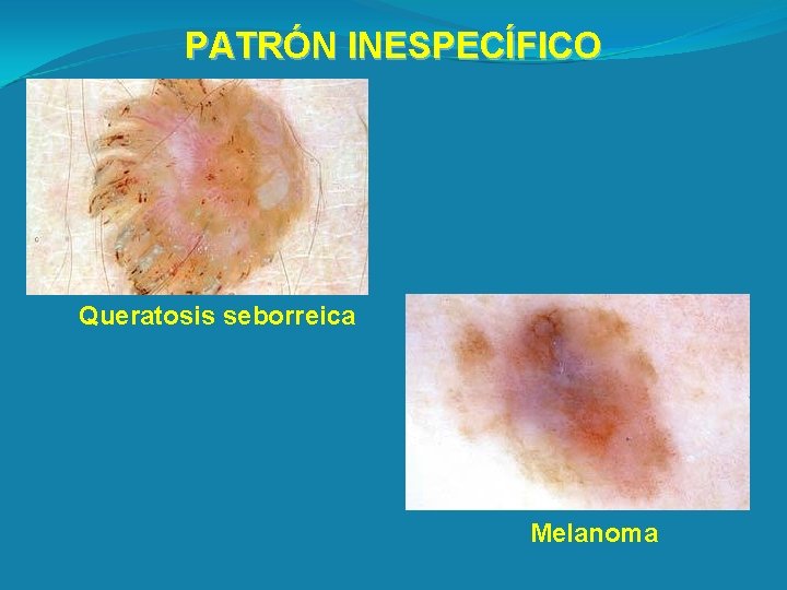 PATRÓN INESPECÍFICO Queratosis seborreica Melanoma 