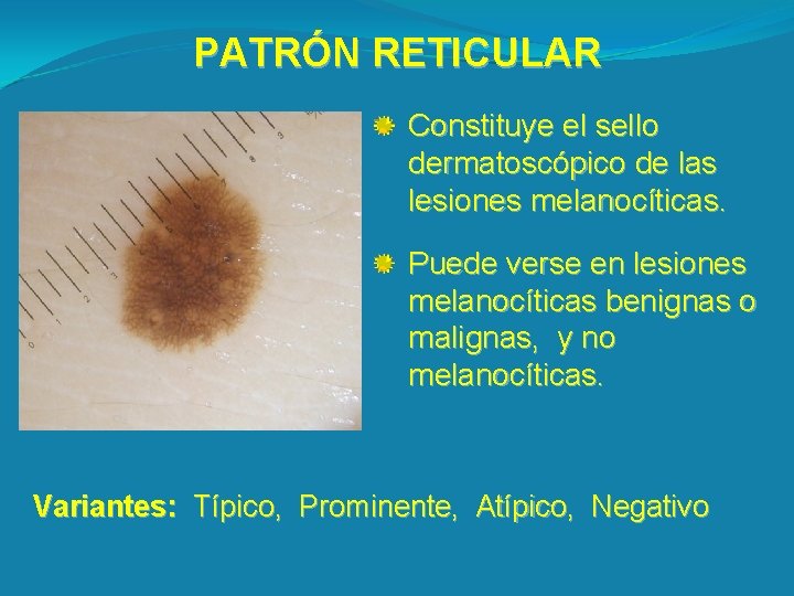 PATRÓN RETICULAR Constituye el sello dermatoscópico de las lesiones melanocíticas. Puede verse en lesiones
