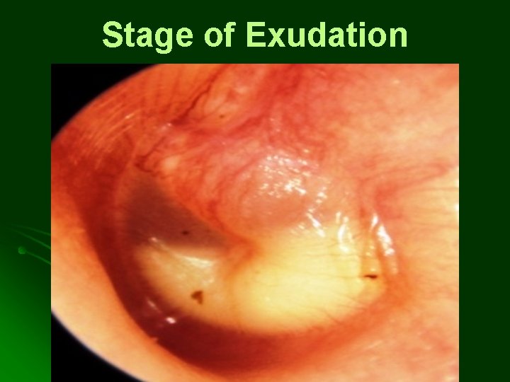 Stage of Exudation Stage of Exudation