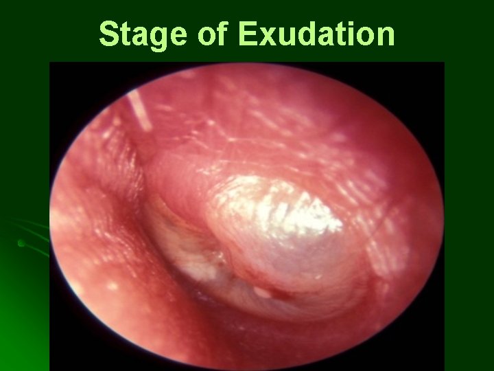 Stage of Exudation Stage of Exudation