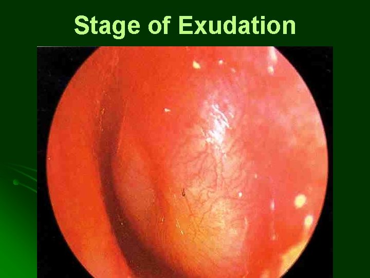 Stage of Exudation Stage of Exudation