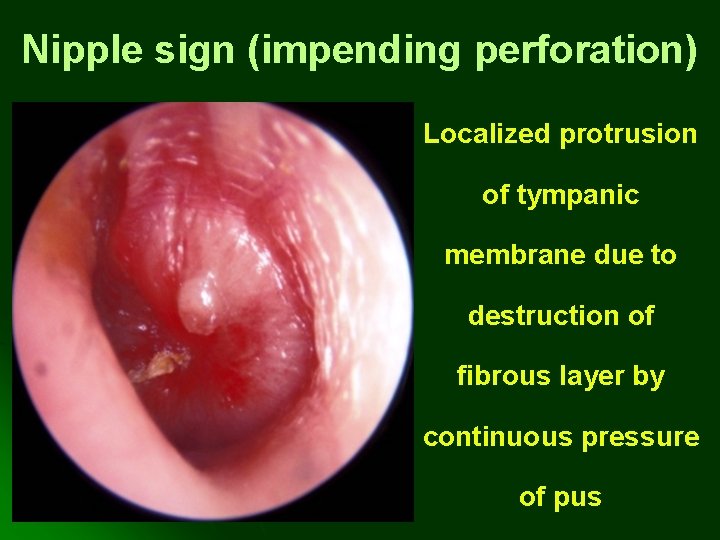 Nipple sign (impending perforation) Localized protrusion of tympanic membrane due to destruction of fibrous Nipple sign (impending perforation) Localized protrusion of tympanic membrane due to destruction of fibrous