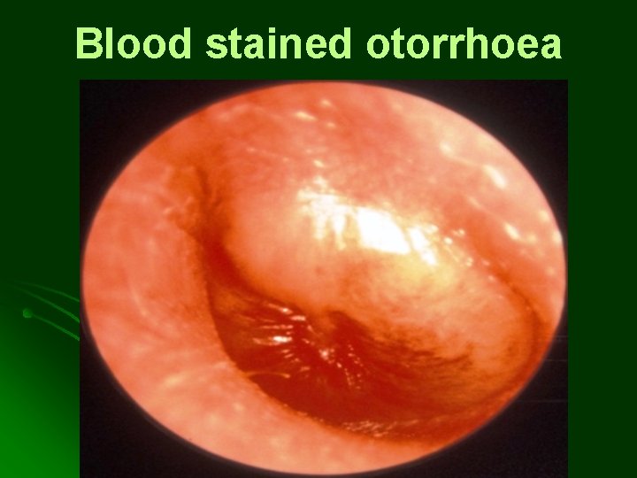 Blood stained otorrhoea Blood stained otorrhoea