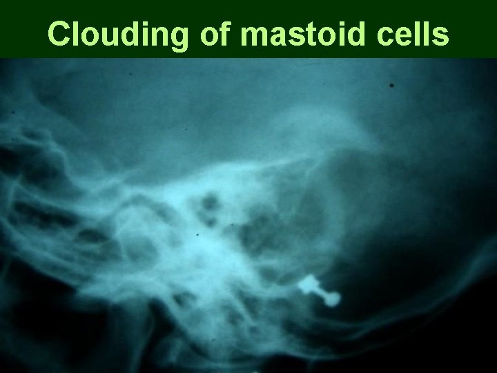 Clouding of mastoid cells Clouding of mastoid cells
