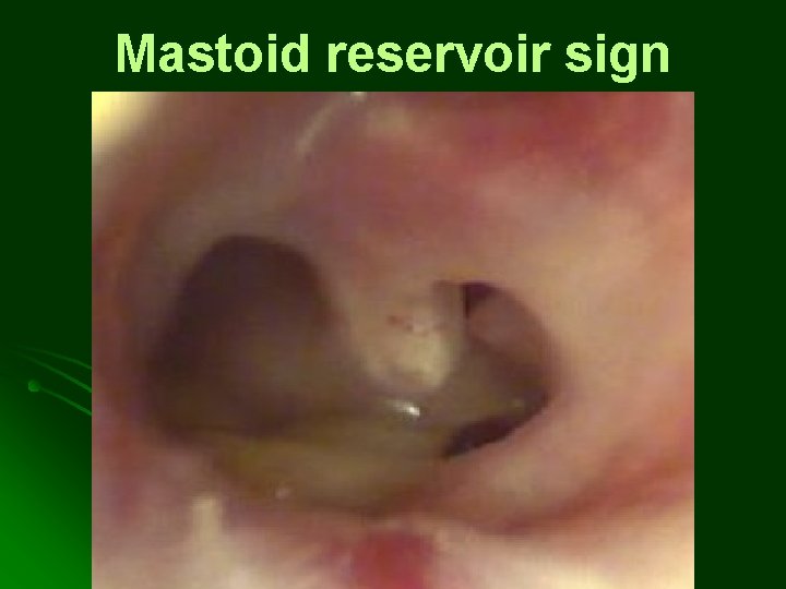 Mastoid reservoir sign Mastoid reservoir sign