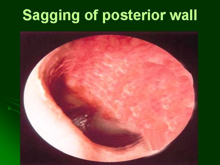 Sagging of posterior wall Sagging of posterior wall
