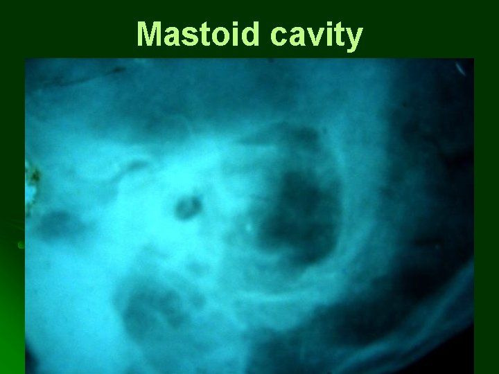 Mastoid cavity Mastoid cavity