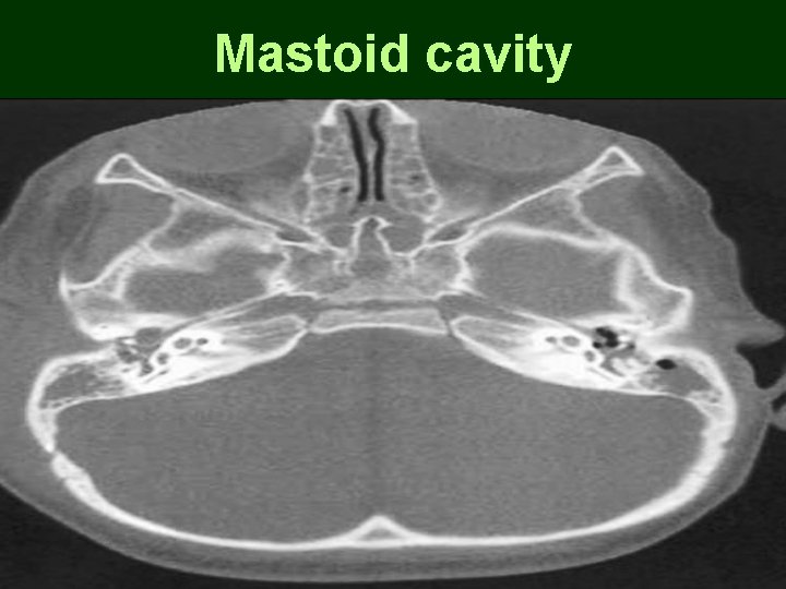 Mastoid cavity Mastoid cavity