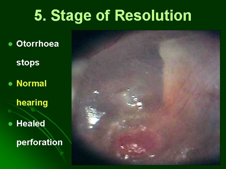 5. Stage of Resolution l Otorrhoea stops l Normal hearing l Healed perforation 5. Stage of Resolution l Otorrhoea stops l Normal hearing l Healed perforation