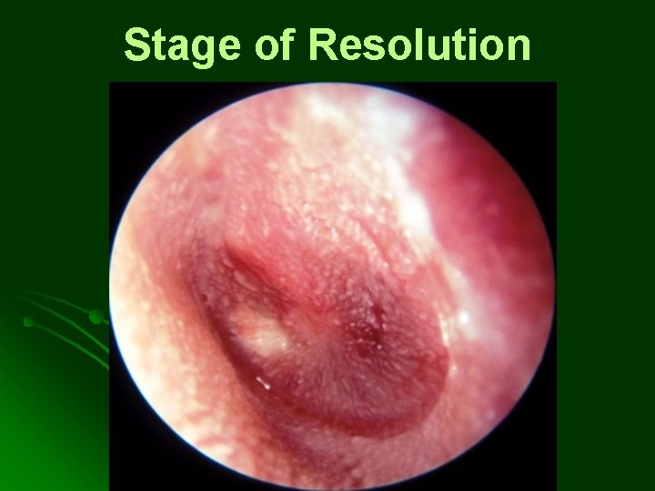 Stage of Resolution Stage of Resolution