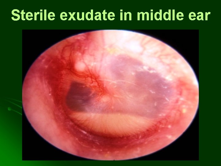 Sterile exudate in middle ear Sterile exudate in middle ear