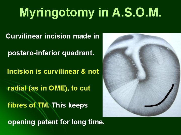 Myringotomy in A. S. O. M. Curvilinear incision made in postero-inferior quadrant. Incision is Myringotomy in A. S. O. M. Curvilinear incision made in postero-inferior quadrant. Incision is