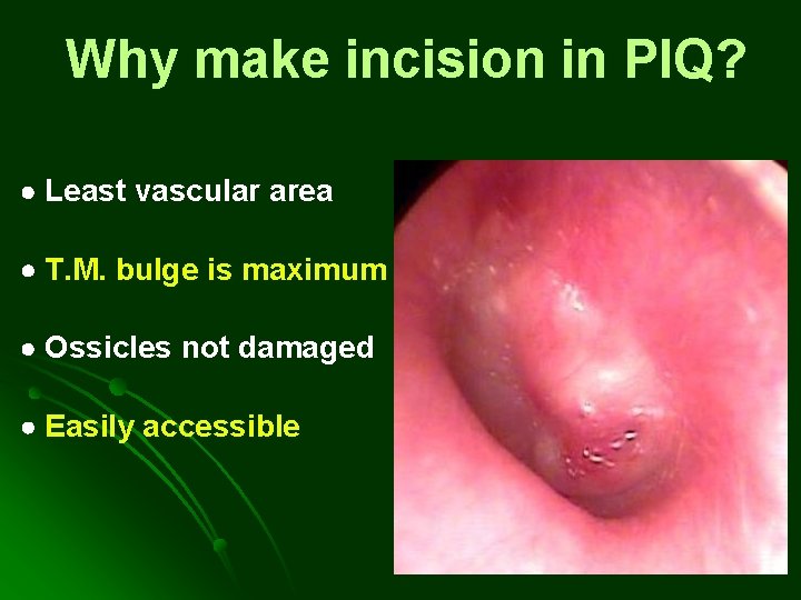 Why make incision in PIQ? Least vascular area T. M. bulge is maximum Ossicles Why make incision in PIQ? Least vascular area T. M. bulge is maximum Ossicles