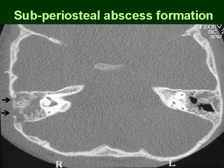 Sub-periosteal abscess formation Sub-periosteal abscess formation