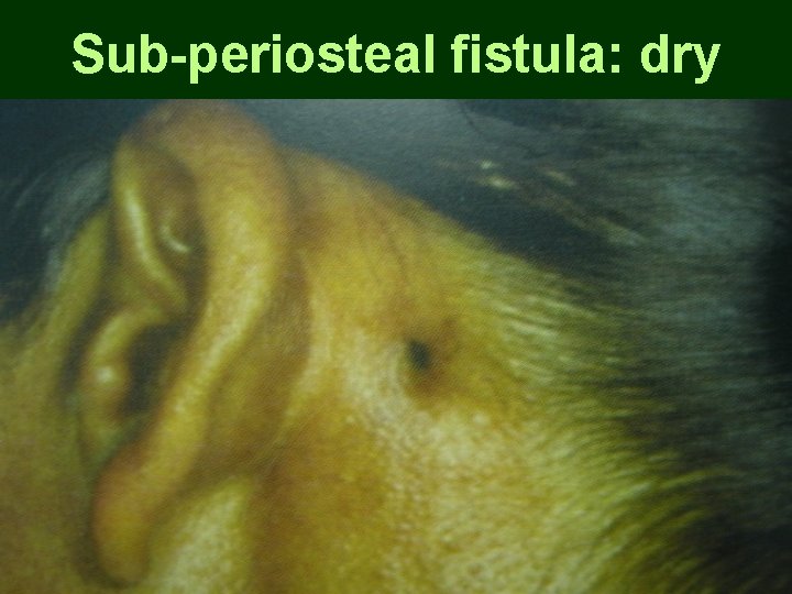 Sub-periosteal fistula: dry Sub-periosteal fistula: dry
