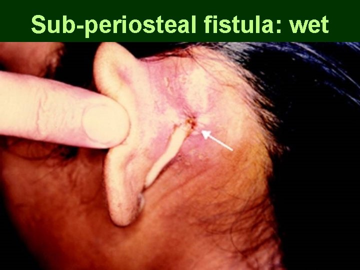 Sub-periosteal fistula: wet Sub-periosteal fistula: wet
