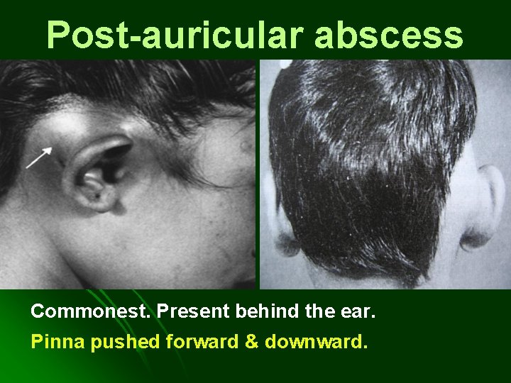Post-auricular abscess Commonest. Present behind the ear. Pinna pushed forward & downward. Post-auricular abscess Commonest. Present behind the ear. Pinna pushed forward & downward.