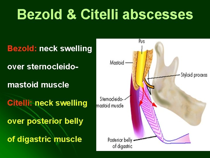 Bezold & Citelli abscesses Bezold: neck swelling over sternocleidomastoid muscle Citelli: neck swelling over Bezold & Citelli abscesses Bezold: neck swelling over sternocleidomastoid muscle Citelli: neck swelling over