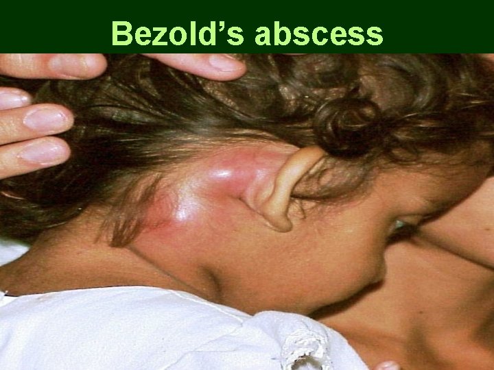 Bezold’s abscess Bezold’s abscess