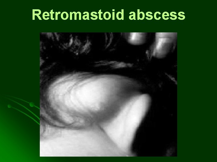Retromastoid abscess Retromastoid abscess