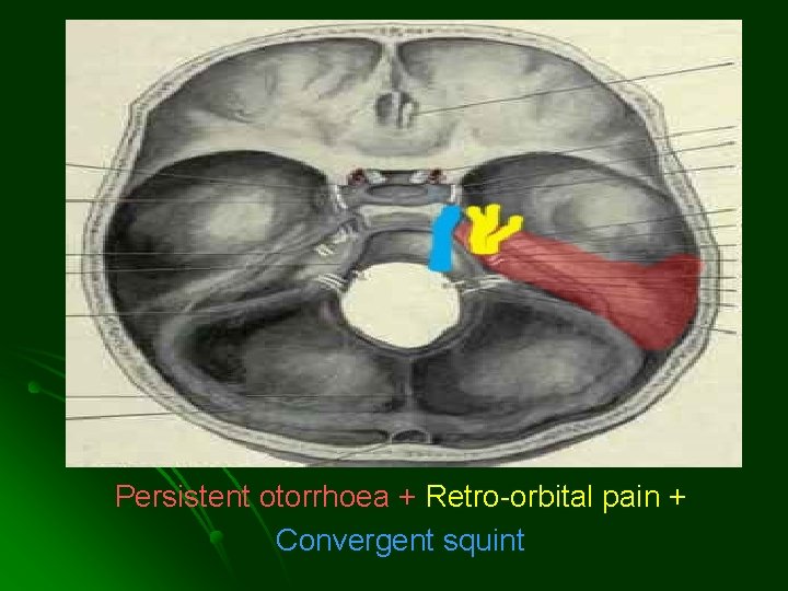 Persistent otorrhoea + Retro-orbital pain + Convergent squint Persistent otorrhoea + Retro-orbital pain + Convergent squint