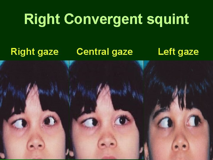 Right Convergent squint Right gaze Central gaze Left gaze Right Convergent squint Right gaze Central gaze Left gaze