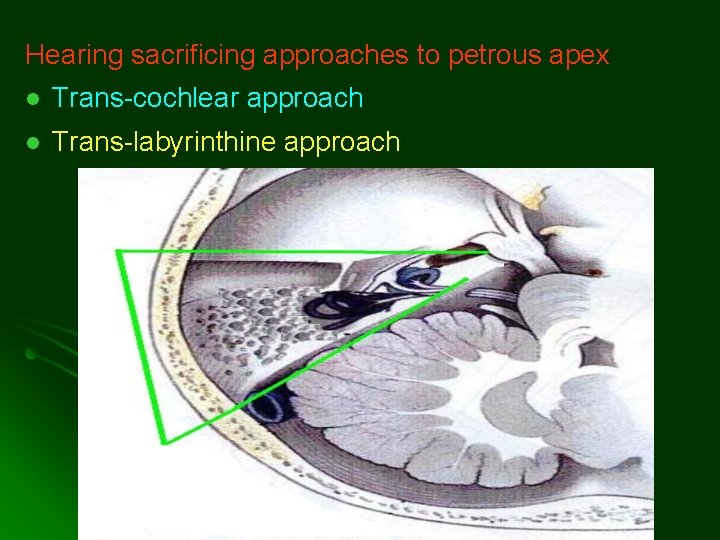 Hearing sacrificing approaches to petrous apex l Trans-cochlear approach l Trans-labyrinthine approach Hearing sacrificing approaches to petrous apex l Trans-cochlear approach l Trans-labyrinthine approach