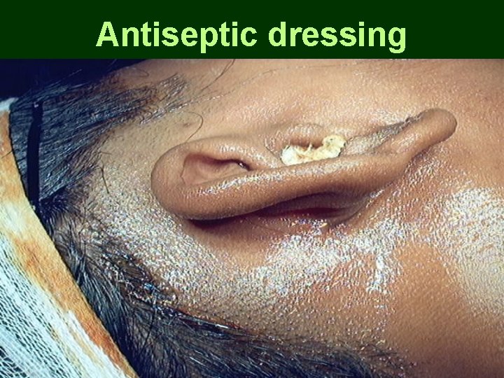 Antiseptic dressing Antiseptic dressing
