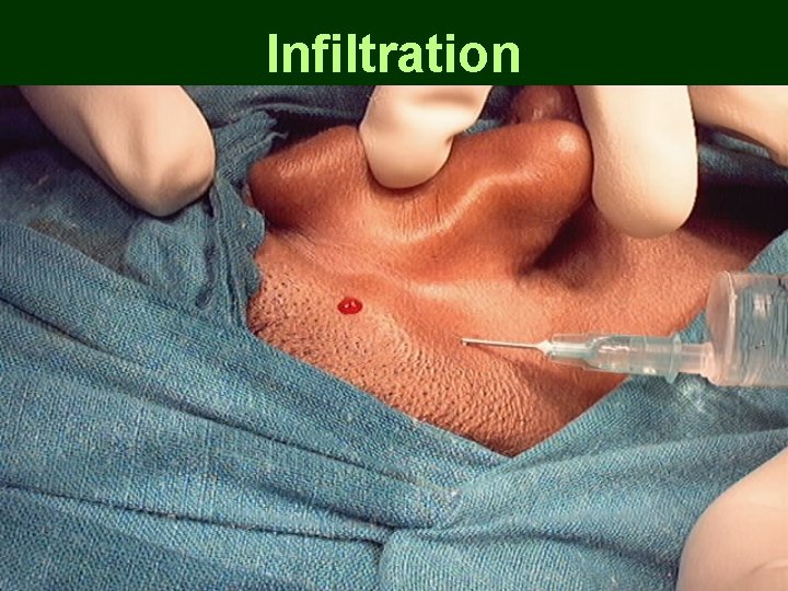 Infiltration Infiltration