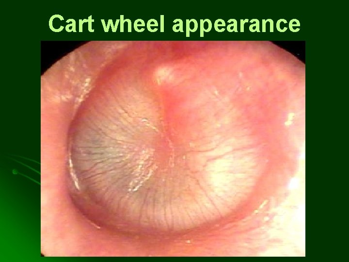 Cart wheel appearance Cart wheel appearance