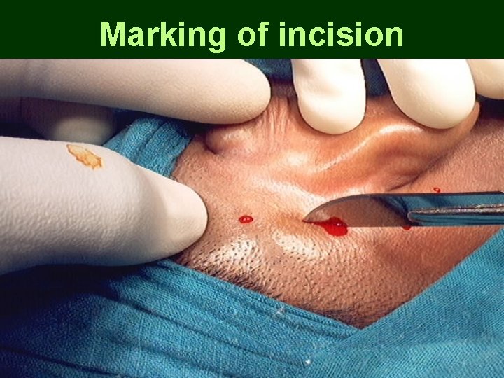 Marking of incision Marking of incision