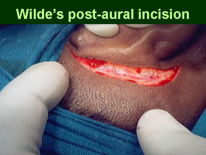 Wilde’s post-aural incision Wilde’s post-aural incision
