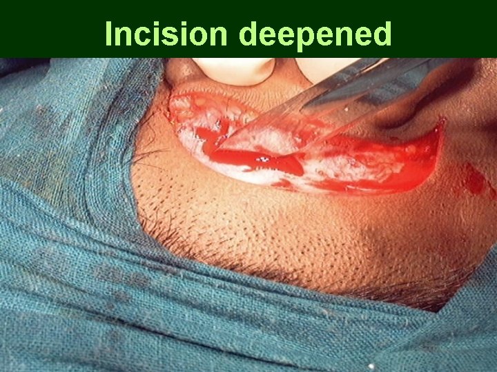 Incision deepened Incision deepened