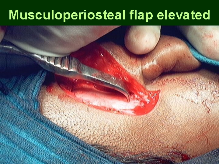 Musculoperiosteal flap elevated Musculoperiosteal flap elevated