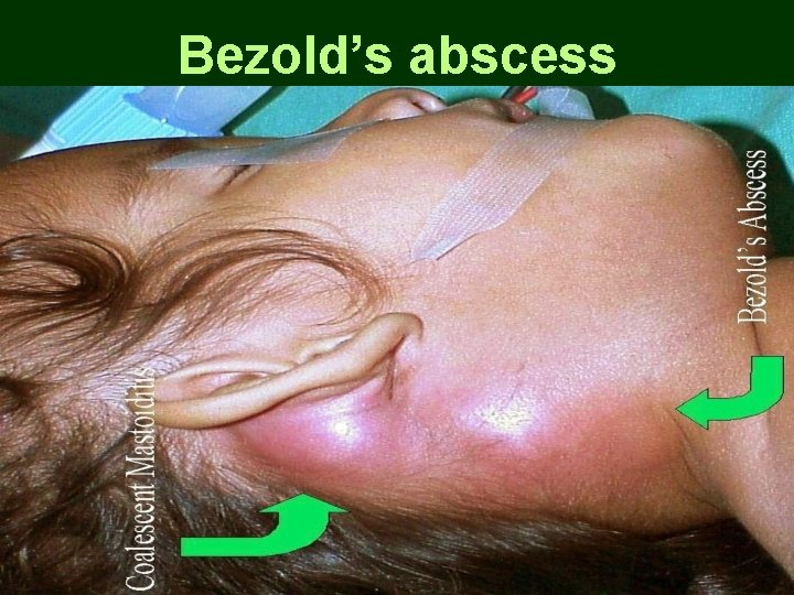 Bezold’s abscess Bezold’s abscess