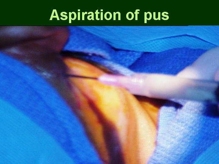 Aspiration of pus Aspiration of pus