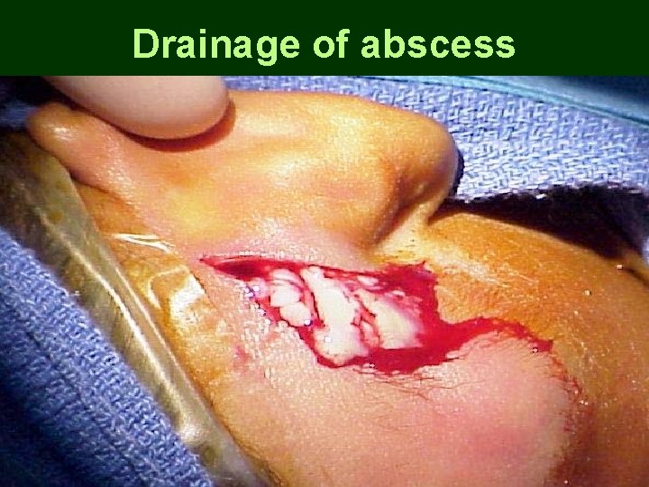 Drainage of abscess Drainage of abscess