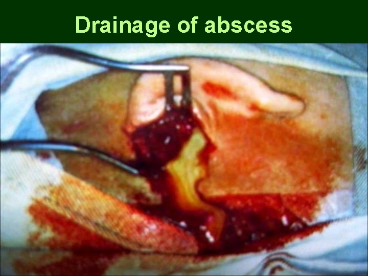 Drainage of abscess Drainage of abscess