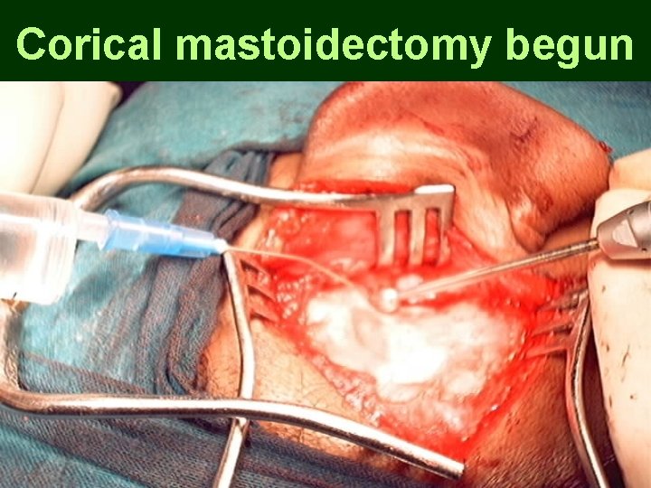 Corical mastoidectomy begun Corical mastoidectomy begun