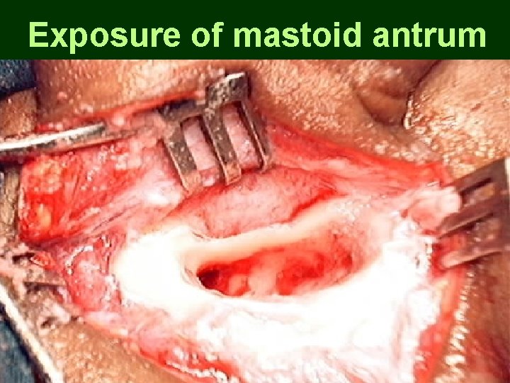 Exposure of mastoid antrum Exposure of mastoid antrum