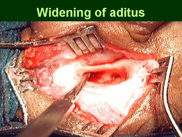 Widening of aditus Widening of aditus