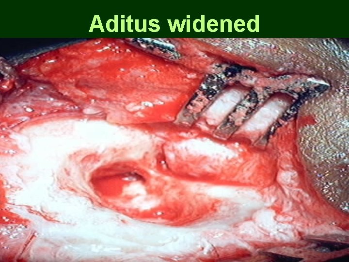 Aditus widened Aditus widened