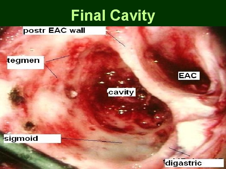 Final Cavity Final Cavity