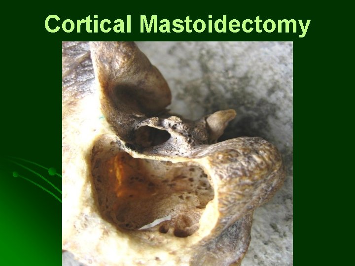 Cortical Mastoidectomy Cortical Mastoidectomy