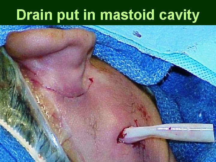 Drain put in mastoid cavity Drain put in mastoid cavity