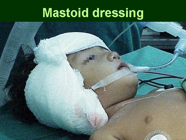 Mastoid dressing Mastoid dressing