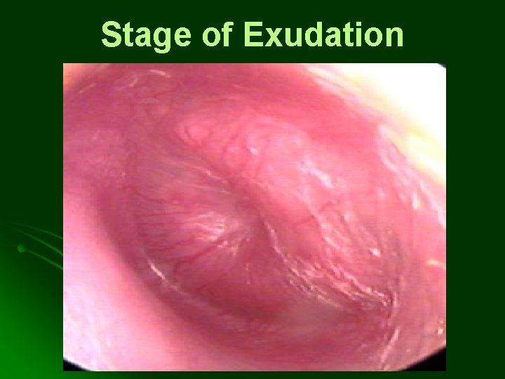 Stage of Exudation Stage of Exudation